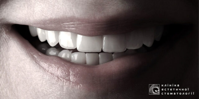 Life Expectancy of Dental Restorations photo