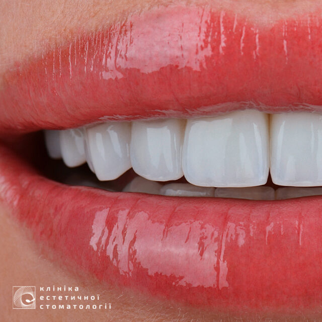 Life Expectancy of Dental Restorations photo