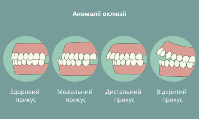 Аномалії окклюзії