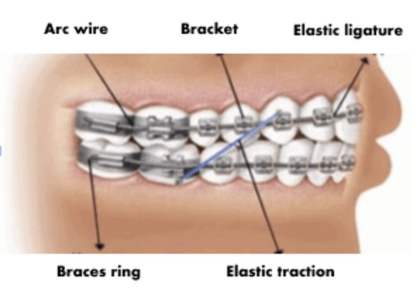 Schematic explanation of the elements of a brace system