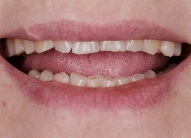 Пациентку беспокоила значительная стираемость зубов, особенно во фронтальном участке.
