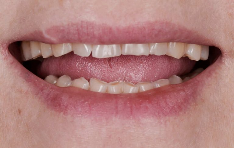 Rehabilitation with ceramic restorations of a patient with teeth abrasion