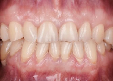 Бажанням було відновити анатомічну форму стертих зубів і отримати гарну білосніжну посмішку.