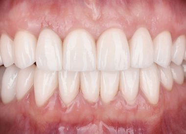 Цей клінічний випадок цікавий тим, що в короткі терміни, за допомогою простого і бюджетного пристрою-депрограматора, нам вдалося визначити справжню висоту стертих зубів і центральне співвідношення щелеп.
