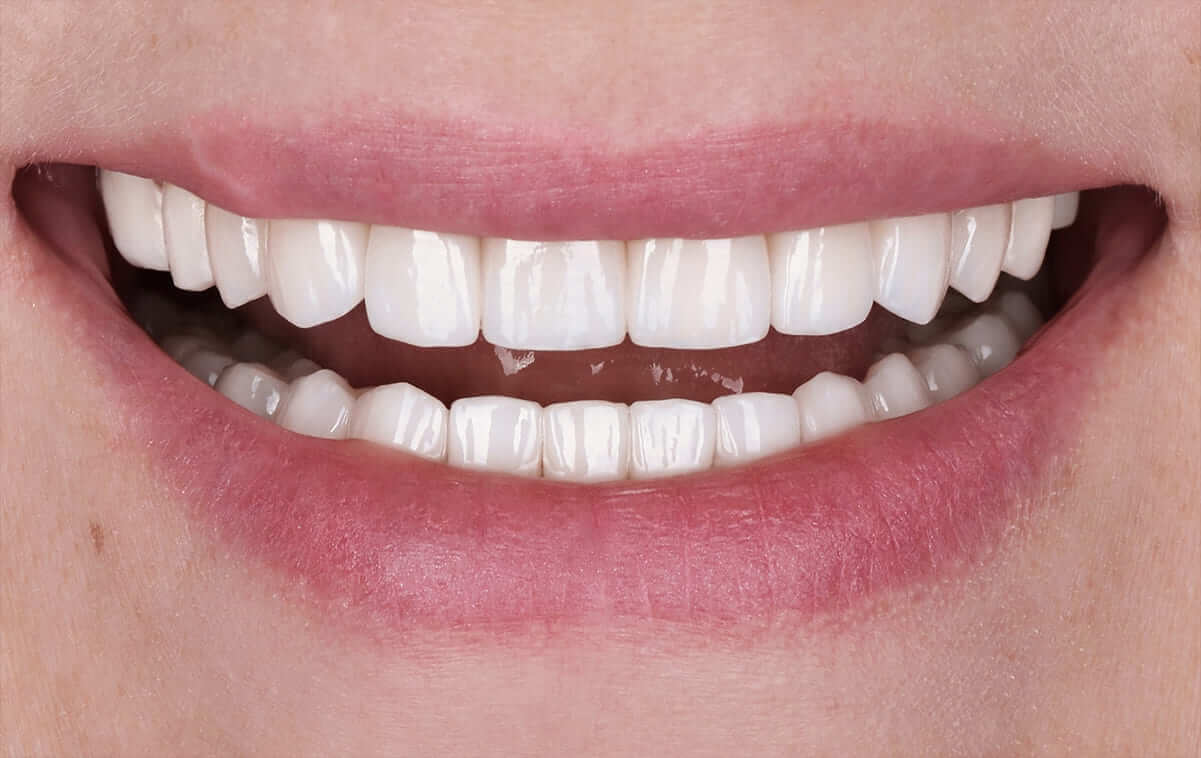 Реабилитация керамическими реставрациями пациента со стираемостью зубов