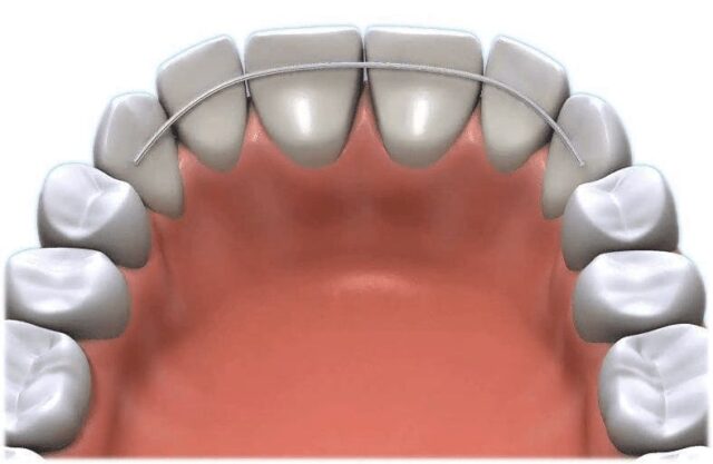 What are the braces replaced with