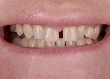The patient made a request to close the diastema, replace the maxillary left milk canine with a permanent one and make the smile more attractive.