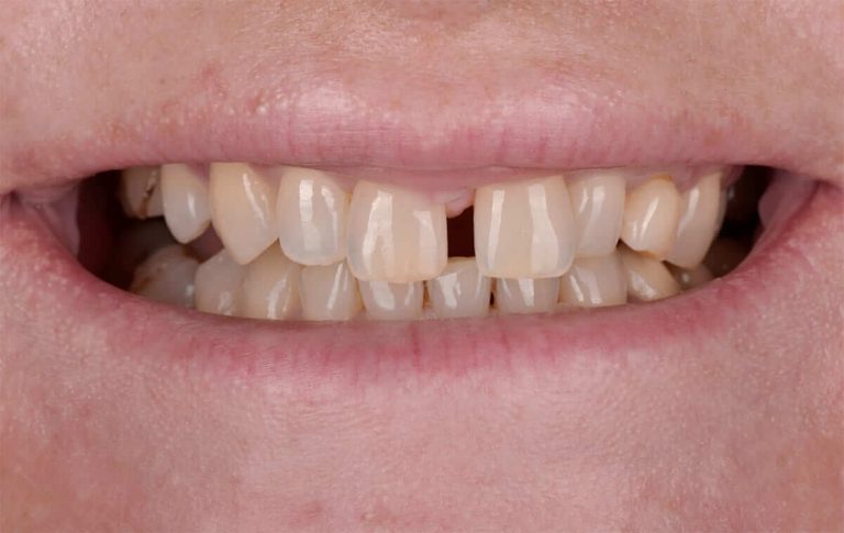 Orthopedic rehabilitation of an orthodontic patient with diastema