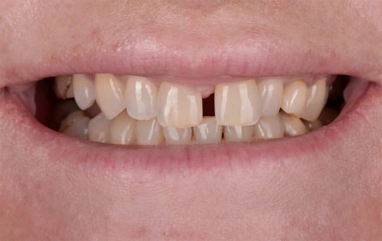 The patient made a request to close the diastema, replace the maxillary left milk canine with a permanent one and make the smile more attractive.