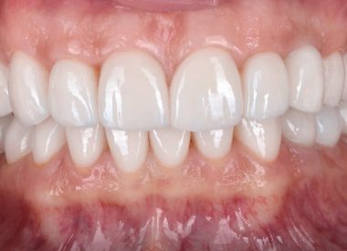 Two months later, the patient got ceramic restorations.