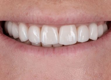 It was a challenging task to close the gap (diastema) between the central incisors without orthodontic treatment and create a symmetrical gingival margin of the upper jaw.