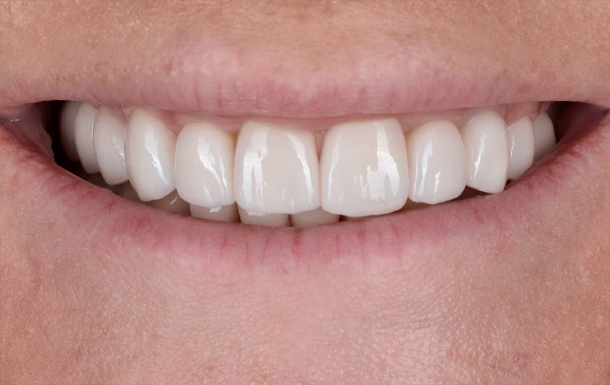 Orthopedic rehabilitation of an orthodontic patient with diastema