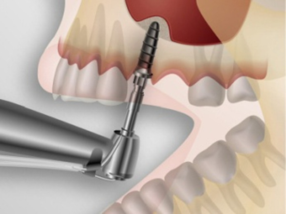 Implantation with immediate loading In terms of closed and balloon sinus lift