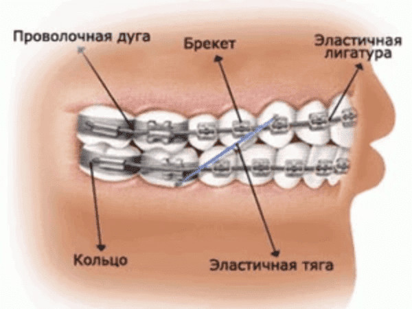 Схематическое объяснение элементов брекет-системы