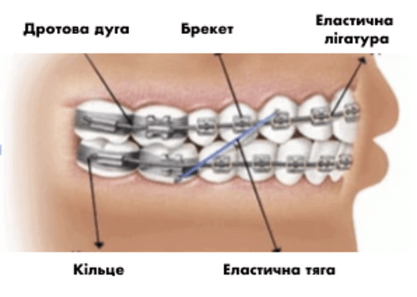 Схематичне пояснення елементів брекет-системи