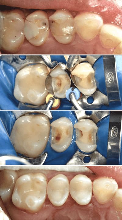 прямая реставрация зубов