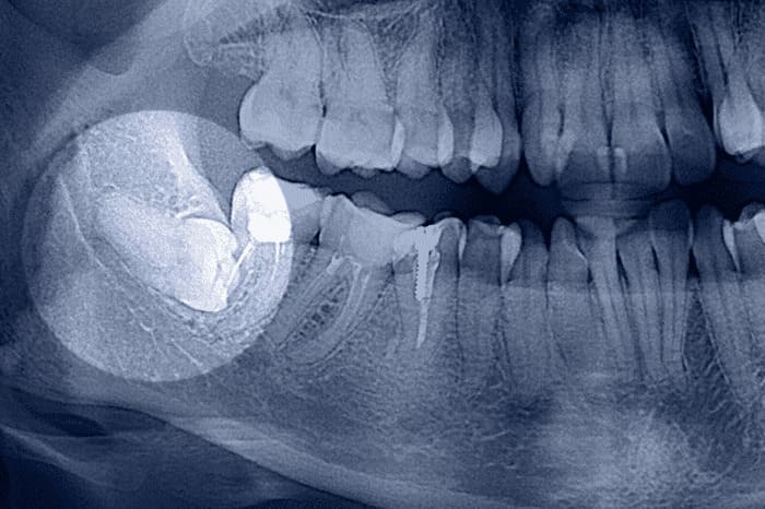 displaced tooth
