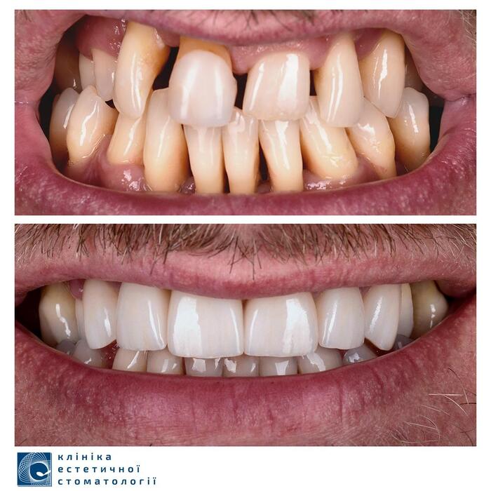 Естетична реставрація зубів