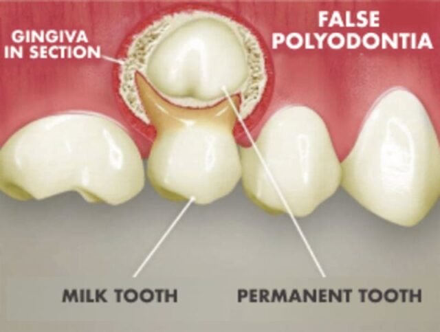 False polydontia