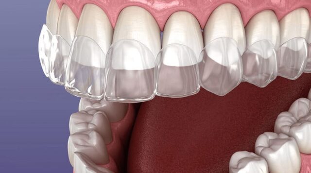 Сколько времени нужно для исправления прикуса