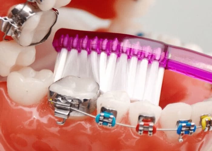 Как следить за гигиеной зубов?