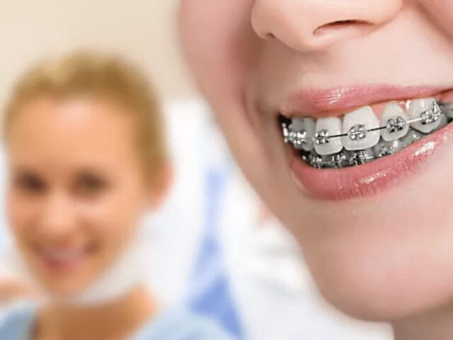 Как правильно ухаживать за брекетами?