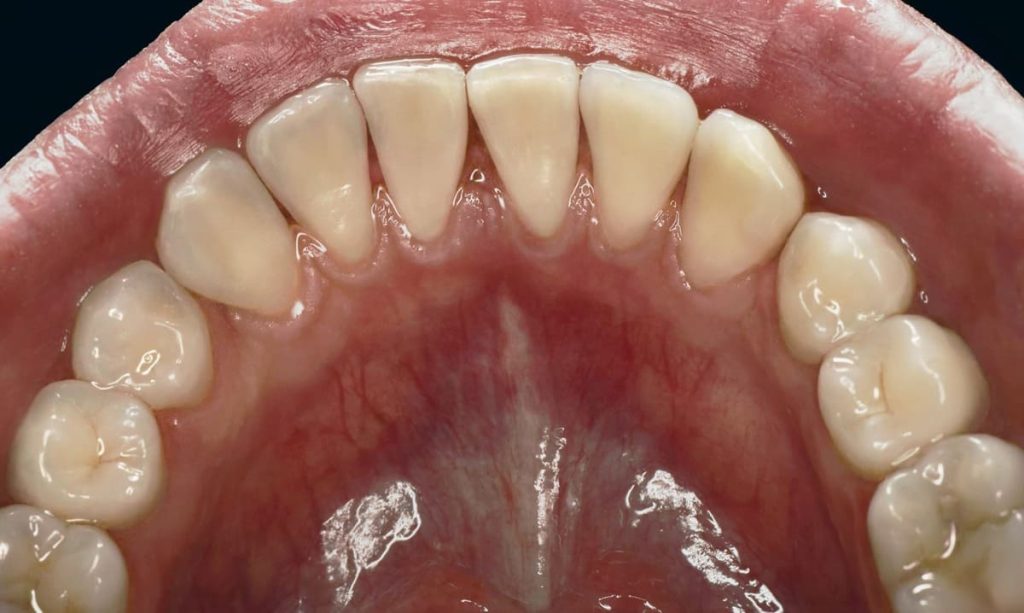 Зуби після гігієнічної чистки