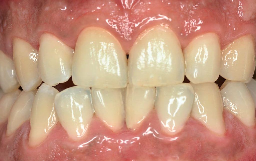 Зубы пациента после гигиенической чистки