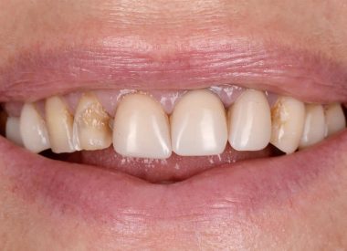 Пацієнтка звернулася в нашу клініку з бажанням замінити старі фотополімерні реставрації, прибрати запалення м'яких тканин навколо зубів, покращити форму зубів і зробити їх світліше.
