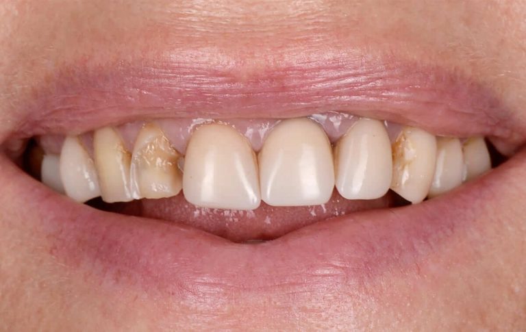 Prosthetics with ceramic veneers of a patient with multiple chips of old photopolymer restorations