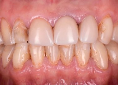 The peculiarity of this work is the minimal invasive (minor) preparation of teeth; the thickness of the restorations supposed to be no more than 0.4 mm.