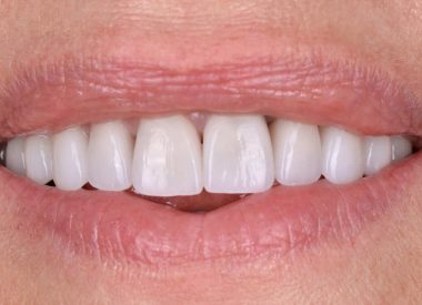 Ten days later, the veneers and crowns were fixed in the oral cavity.