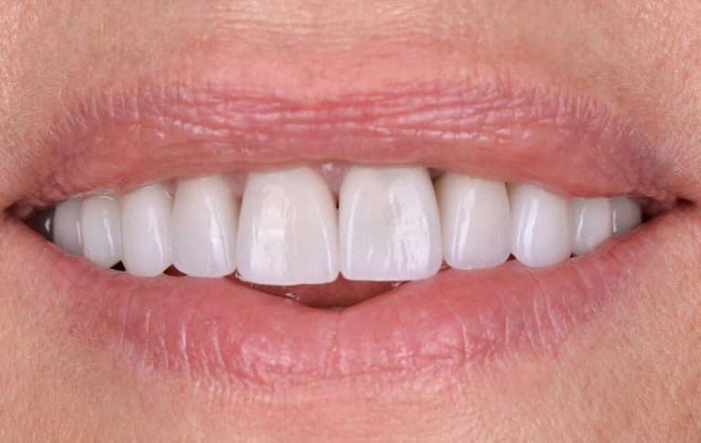 Prosthetics with ceramic veneers of a patient with multiple chips of old photopolymer restorations