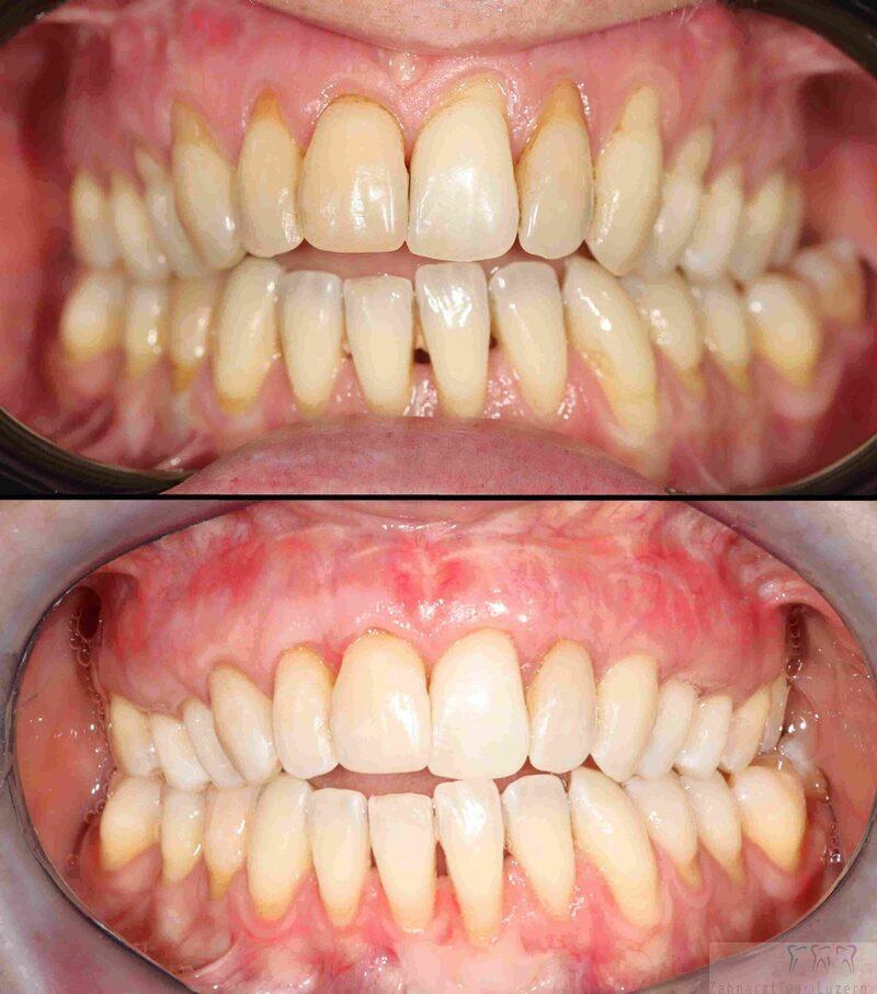 Симптомы абсцесса зуба