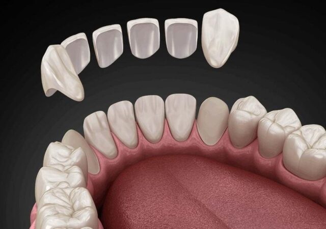 How are dental veneers made