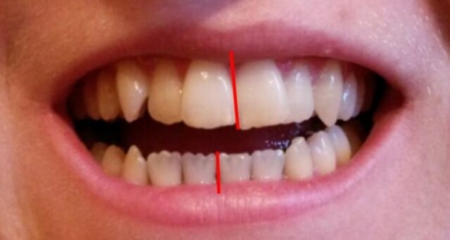 Displacement of the center line of teeth as an example