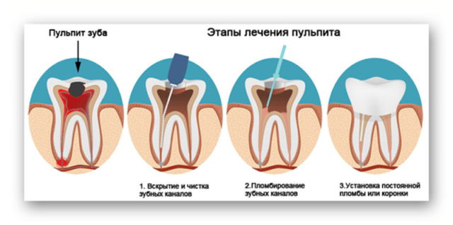С чего начать лечение запущенных зубов