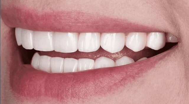 Life Expectancy of Dental Restorations