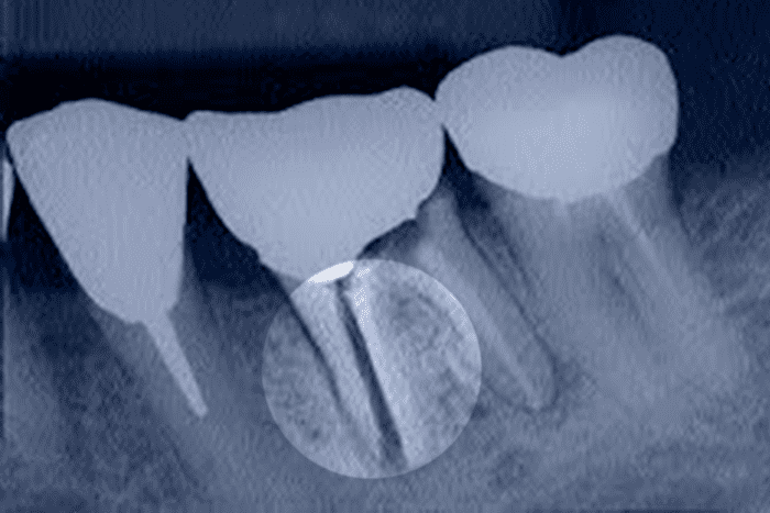 Зуб з поздовжнім переломом кореня