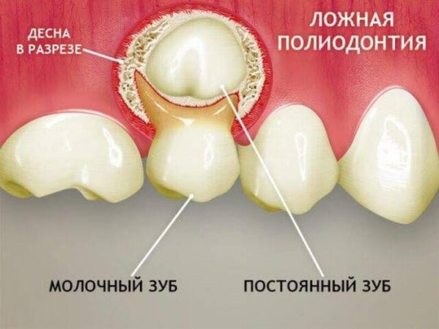Ложная полидонтия