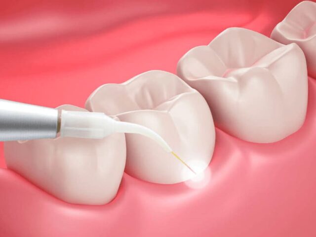 Grinding Down Teeth for Lumineers