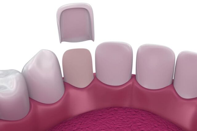 Grinding Down Teeth for Veneers