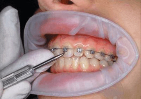 The main stages of removing braces