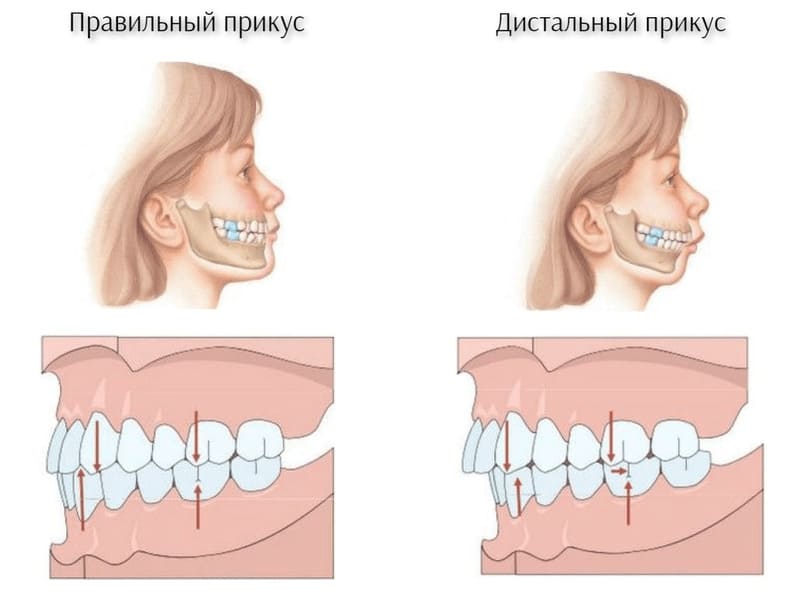 Как брекеты меняют лицо