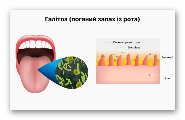 Пояснення причин галітозу на зображеннях