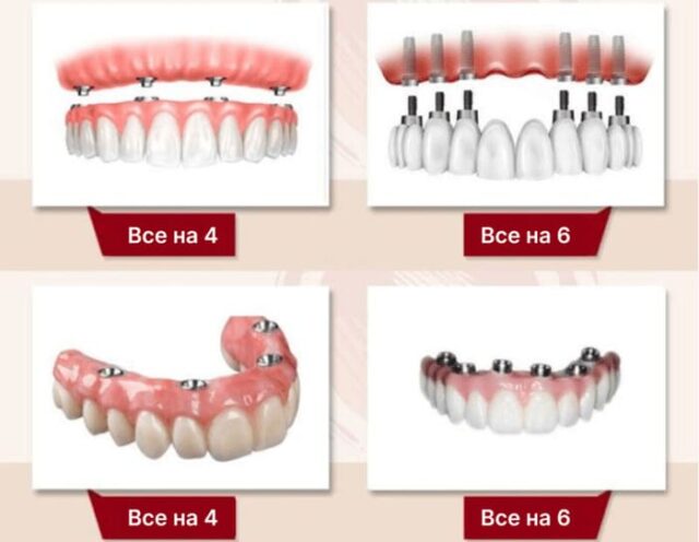 Классификация зубных имплантов