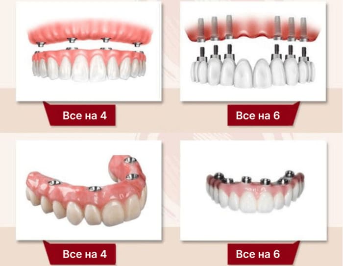 Классификация зубных имплантов