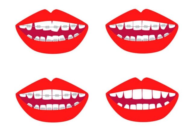 Dentist's recommendations after removing the braces