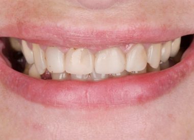 Пацієнтка звернулася з побажанням замінити старі фотополімерні реставрації чотирьох центральних різців на верхній щелепі і зробити зуби світлішими.