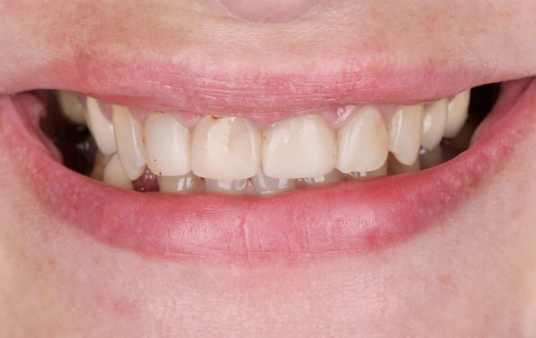 Пациентка обратилась с пожеланием заменить старые фотополимерные реставрации четырех центральных резцов на верхней челюсти и сделать зубы светлее.